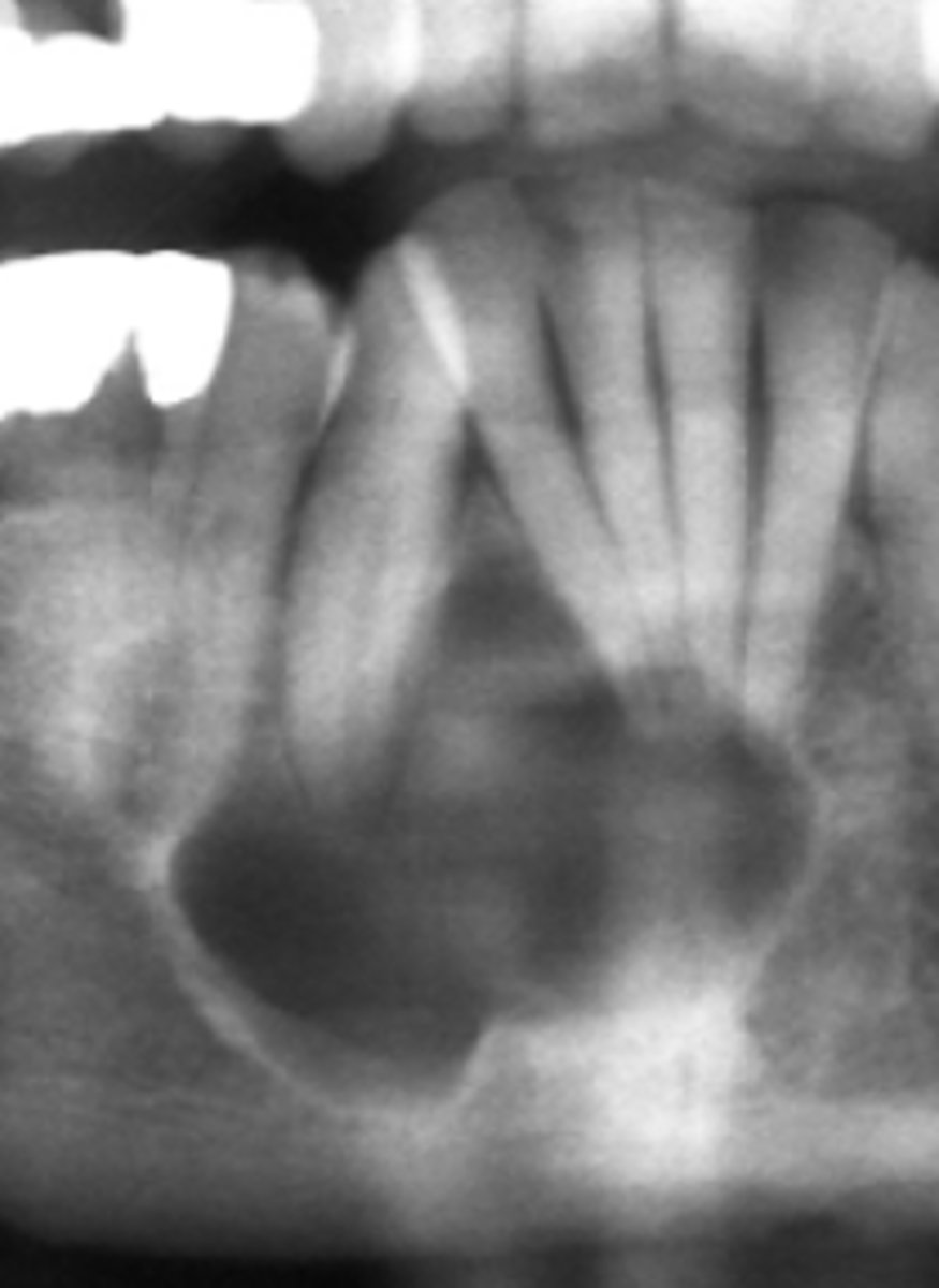 <p>how do you know this is NOT a Simple Bone Cyst/Traumatic bone cyst?</p>