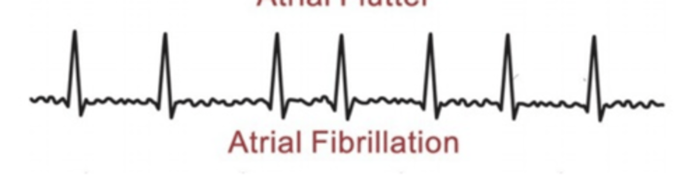 <p>Depolarization currents arise from non-SA node sites throughout the atria <br><br>No discernable P wave and irregular ventricular rate <br><br>FAST, RANDOM</p>