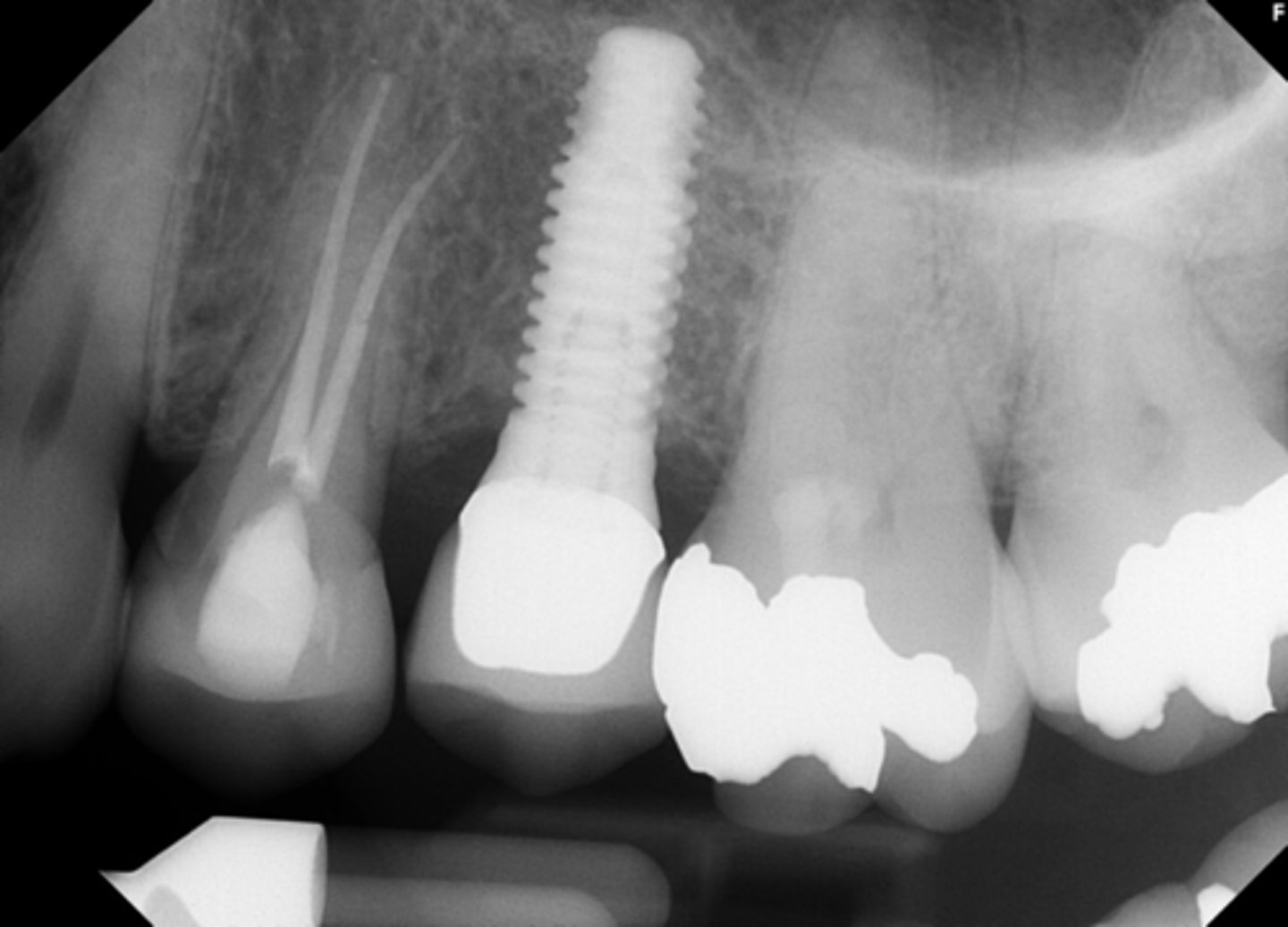<p>ID the pulpal diagnosis:</p><p>- CC: "I have pain when biting on my tooth"</p><p>- Cold test: Negative</p><p>- Radiograph shows endo treatment of problematic tooth</p>