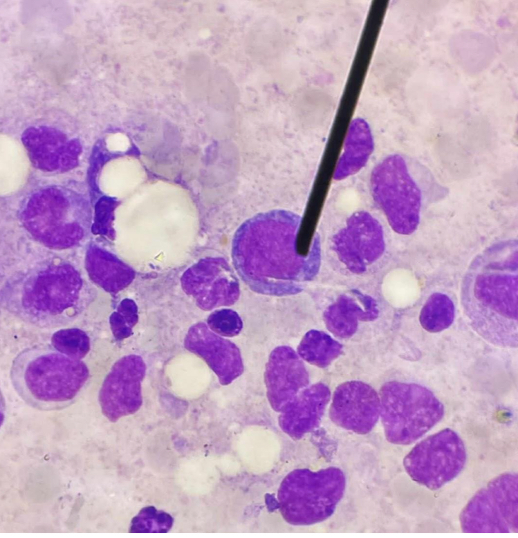 <p>A. Identify the cell (Normoblastic / Rubriblastic / Erythroblastic)</p><p>B. Striking feature </p><p>C. Describe N:C ratio</p>