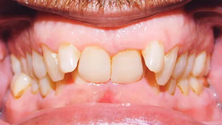 <p>Class II Malocclusion (Distal Occlusion) </p>