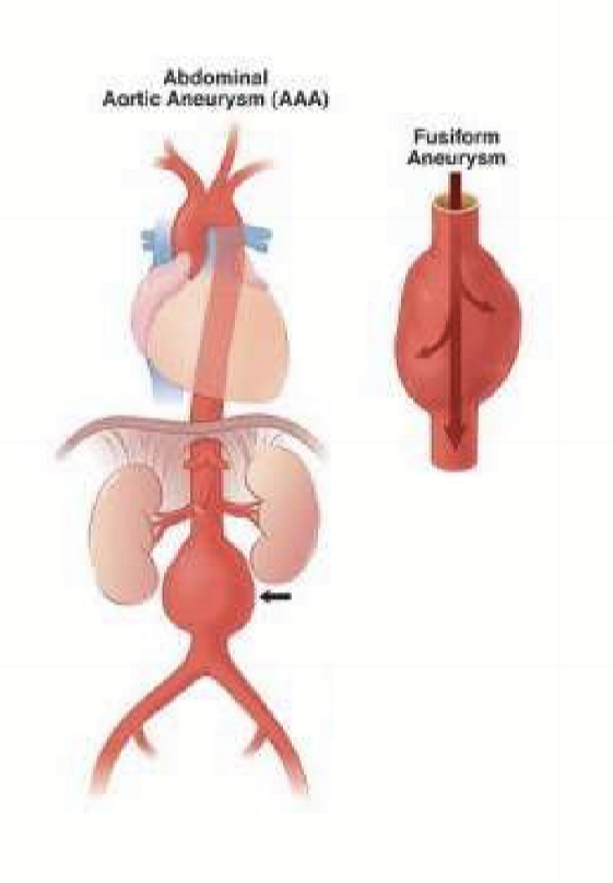 <p>Fusiform aneurysms in the abdominal cavity that are asymptomatic, but can be life-threatening of it ruptures. The are occasionally found during a physical. </p>