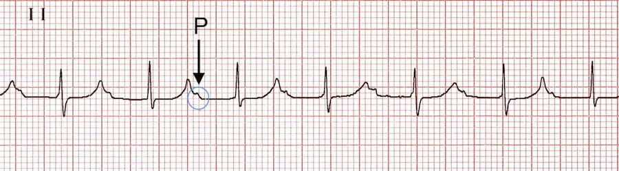 <ul><li><p>rhythm</p></li><li><p>may be normal variant or indicator of disease</p></li><li><p>usually occurs without any symptoms and may require no treatment</p></li></ul><p></p>