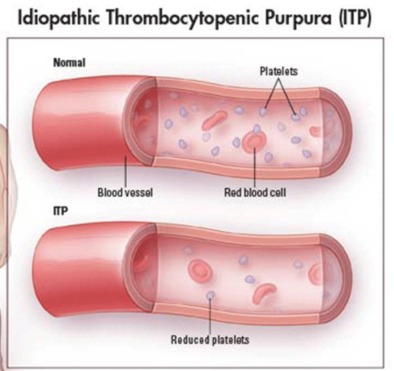 <p>Definition: An abnormal decrease in thrombocytes</p><p>Causes: Decreases in platelet production, reduced platelet survival, enlarged spleen</p>