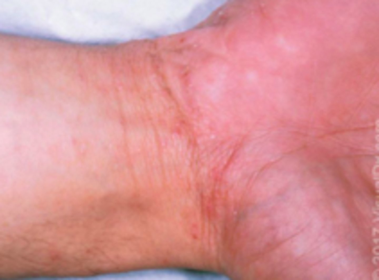 <p>Parasitic ID:</p><p>Objective:</p><p>- Small, erythematous papules, often excoriated - usually in between the fingers</p><p>- Burrows may be visible: thin, gray, red, or brown serpiginous lines</p><p>Miniature wheals, vesicles, pustules, and sometimes bullae also may be present</p><p>Distribution involves more than 1 area because it is rarely localized:</p>