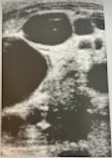 <p>A 4 year old girl is seen by the pediatrician for an abd. mass discovered by the parent. The child is in no physical distress, and mother reports no illness. On questioning family hx, the physician learns that the mother has epilepsy and has been on long term antiseizure meds. The child is referred for a sonogram of the RUQ. The rt kidney was not identified. Discuss the palpable nature of this mass and how the family hx is significant.</p>