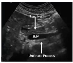 <p>Black = Pancreatic Neck</p><p>Blue = SMV</p><p>Red = Uncinate Process</p>
