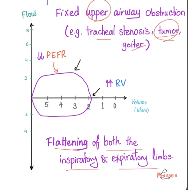 <ul><li><p>Air can’t get in or out e.g upper airway obstruction- trachea, goitre</p></li><li><p>Flattening of both insp and exp limbs</p></li></ul><p></p>