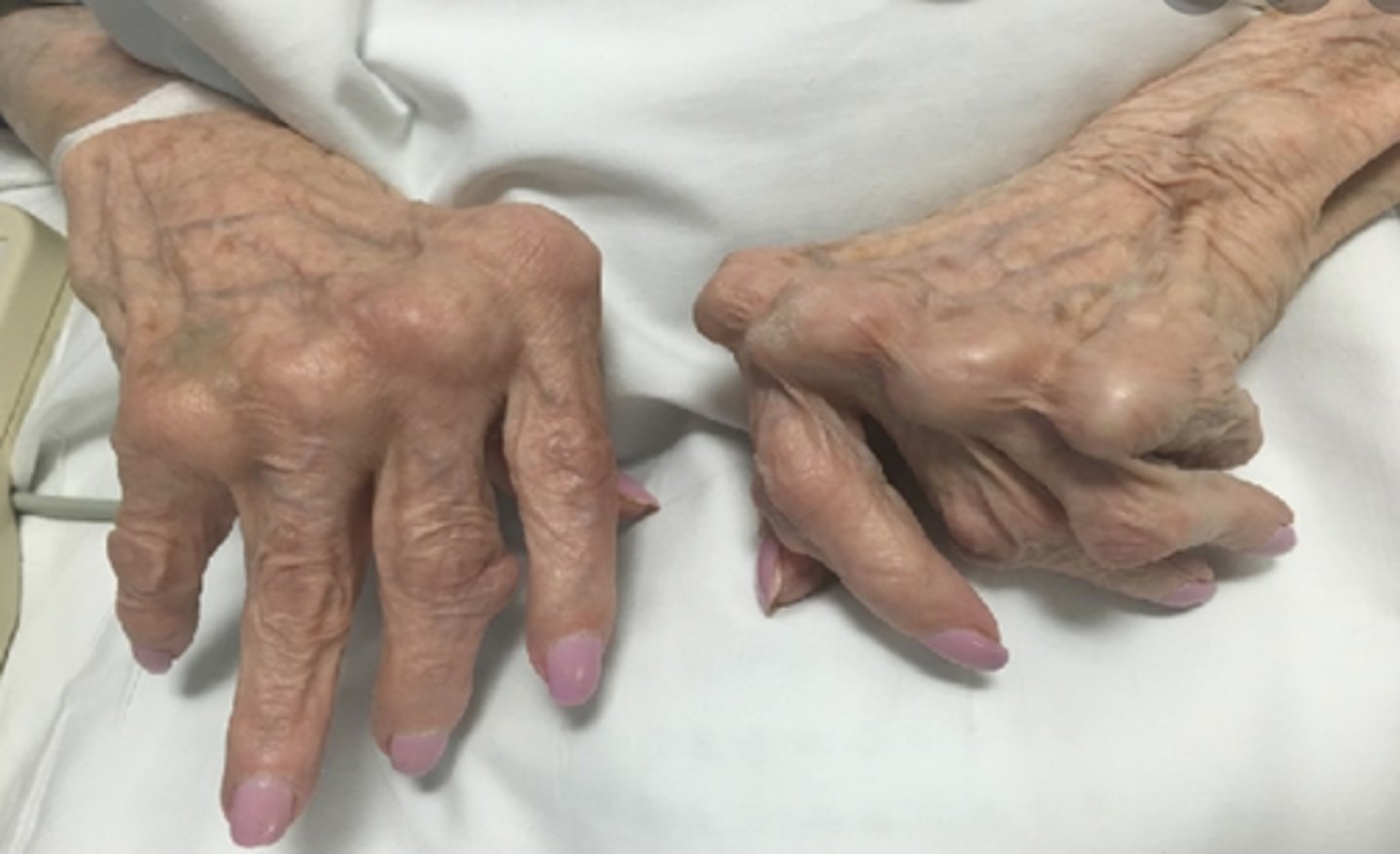 <p>what disease does this picture indicate?</p>