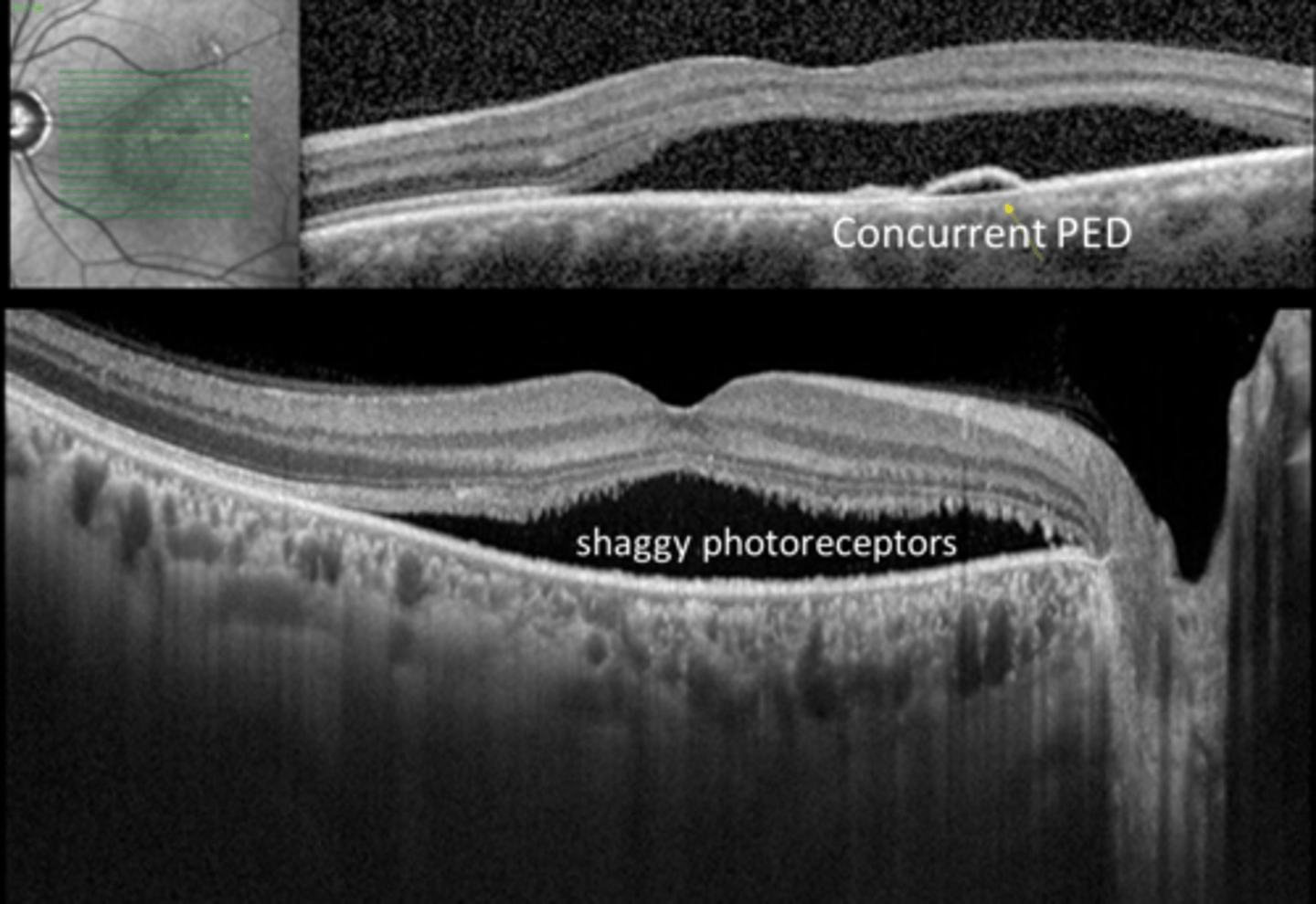 <p>neurosensory RD at central macula</p><p>+/- concurrent PED (RPE detachment)</p><p>+/- shaggy PR's</p>