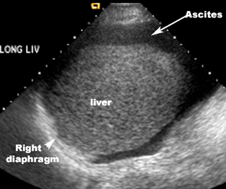 <ul><li><p>fluid collection in the peritoneal cavity</p></li><li><p>inferior to the diaphragm </p></li></ul><p></p>