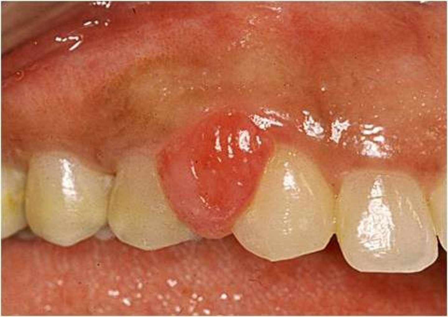 <p>"Pregnancy tumor"- hormonal influenced, especially during pregnancy.</p><p>Granulation tissue in response to local irritant</p><p>Most common in children and young adults during puberty.</p>