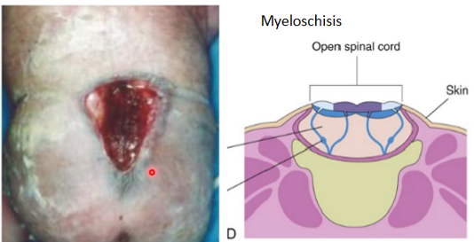 <p>spinal cord is exposed to the outside</p>