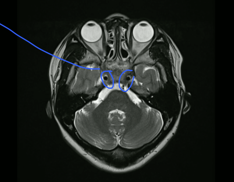<p>What nerve travels here?&nbsp;</p>