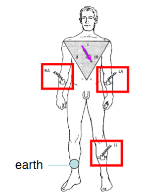 <p><span>Recording electrodes are placed on:</span><br><span>• left arm (LA)</span><br><span>• right arm (RA)</span><br><span>• left leg (LL)</span><br><span>• a fourth electrode on the right leg acts as an electrical earth</span></p>