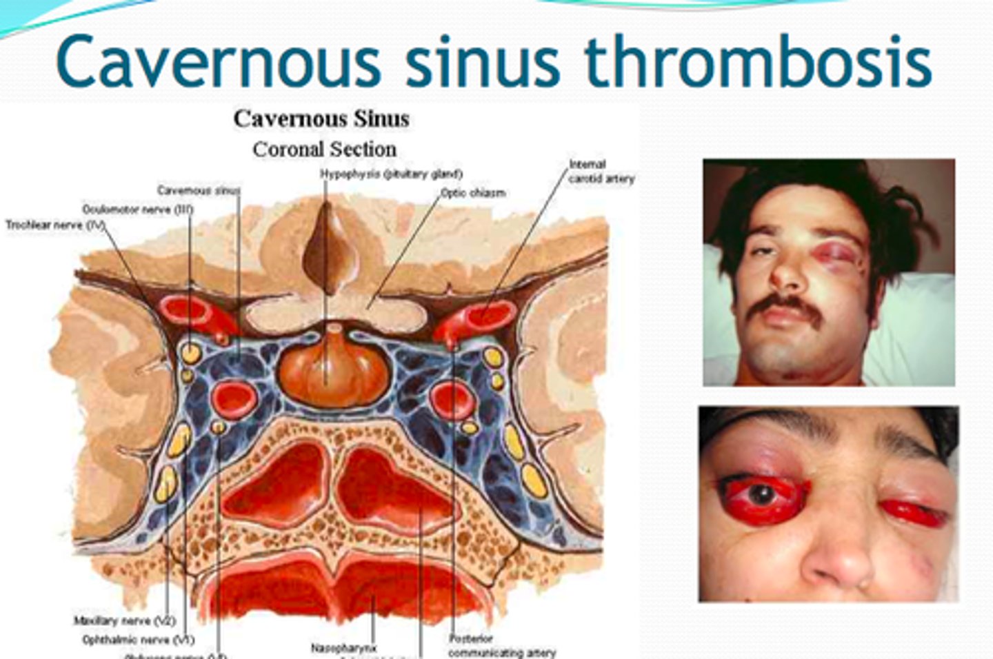 <p>- Orbital cellulitis that travels through angular veins to cavernous sinus</p>