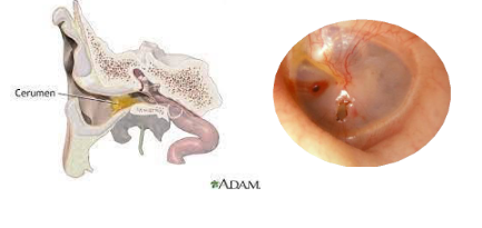 <p><span>§ ear wax</span><br><span>§ perforated ear drum</span><br><span>§ fused ossicles </span></p>