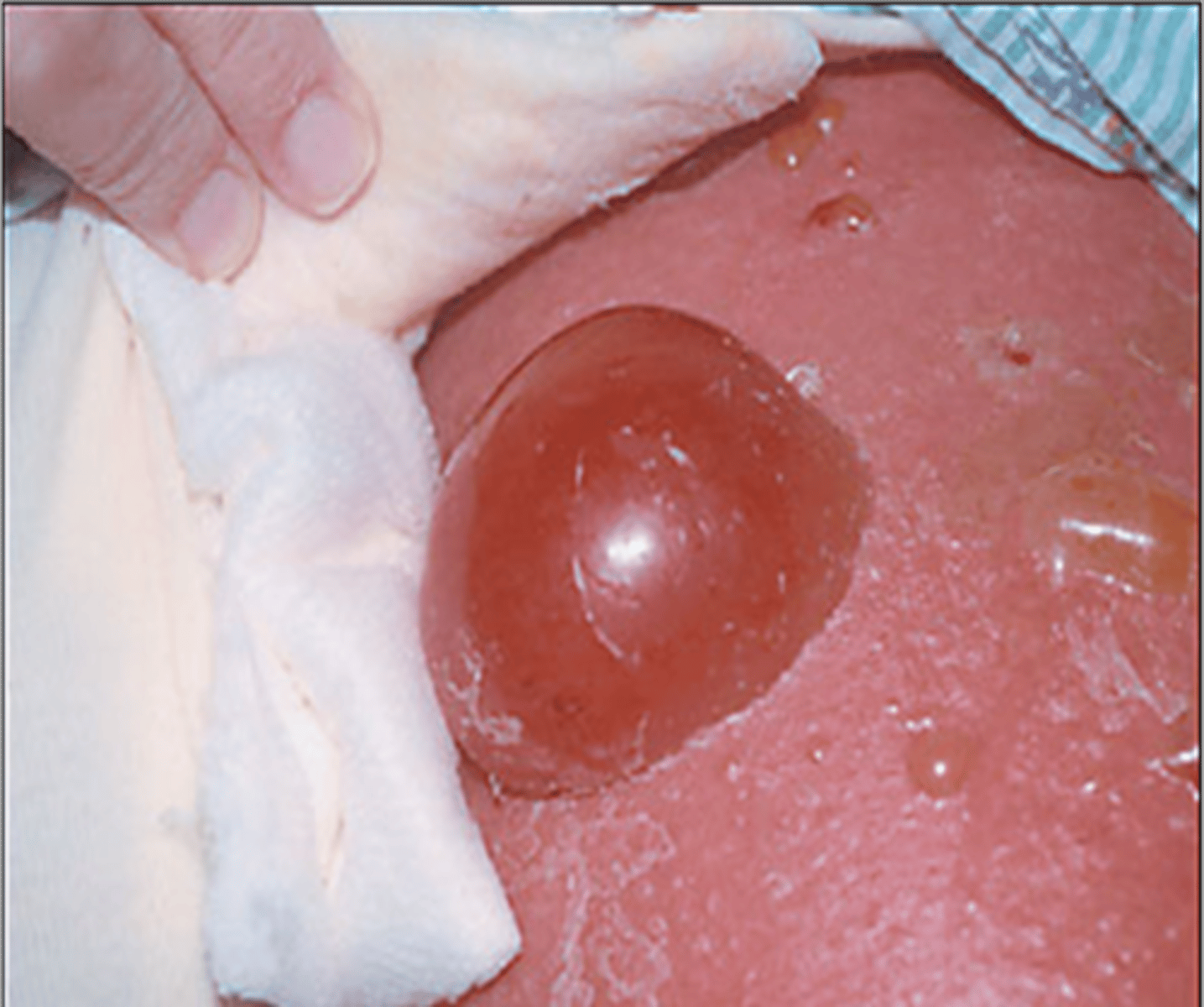 <p>•Circumscribed collection of free fluid</p><p>•&gt; 1 cm</p>