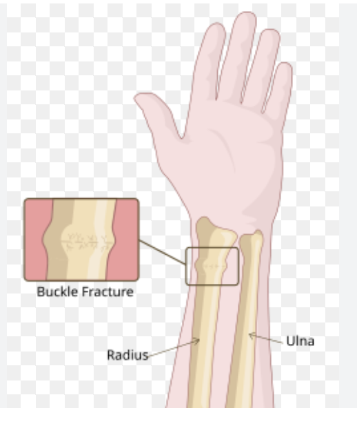 <p>What is a <strong>torus fracture</strong>?</p>