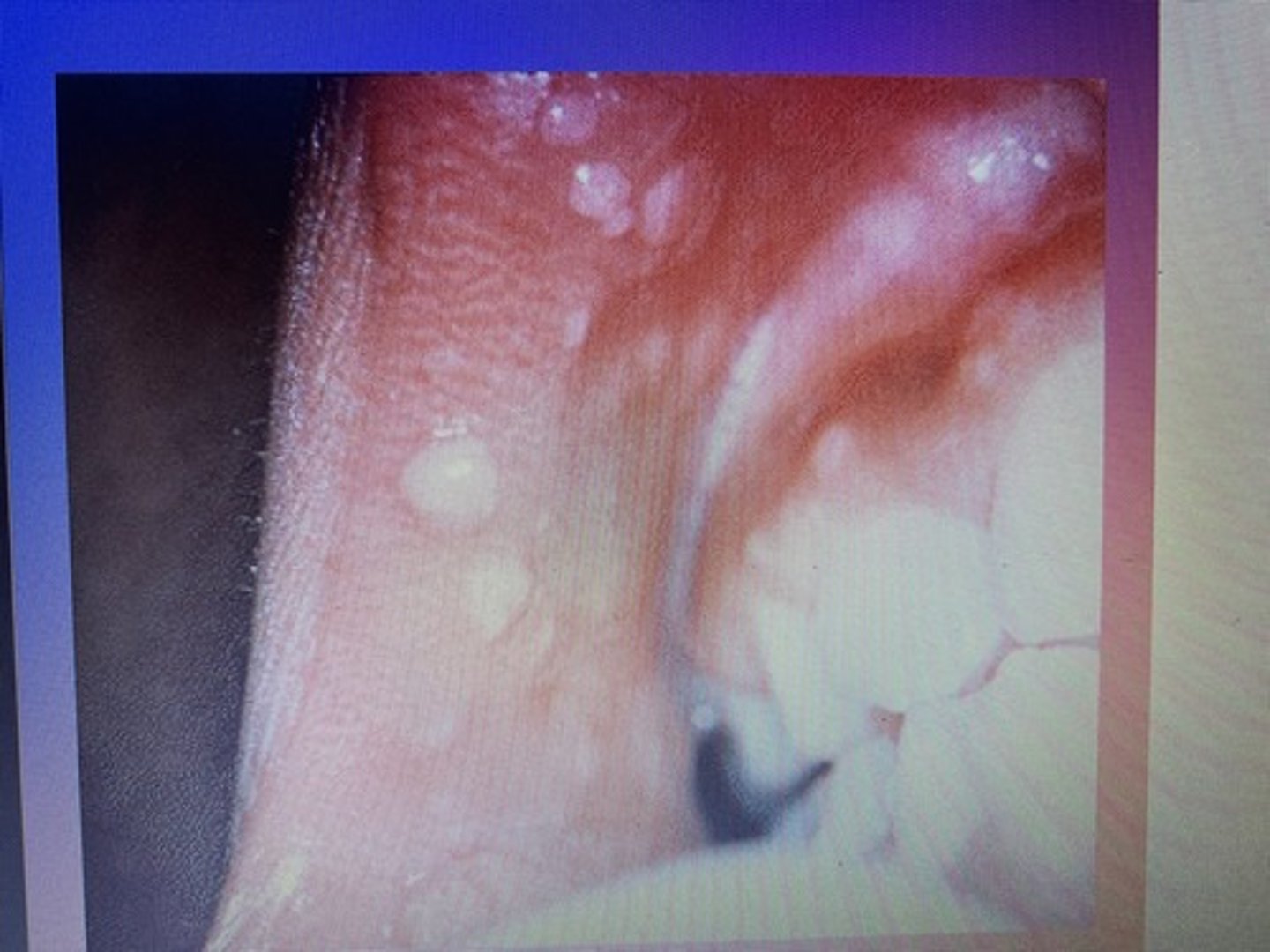 <p>Often seen in children. It is caused by specific strains of the human papilloma virus (HPV) and is not commonly seen in patients with HIV.</p>