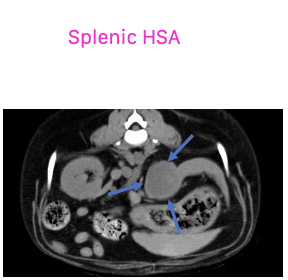 <p>-spleen is the most common location</p><p>-liver</p><p>-other: kidney, retroperitoneal space, nasal cavity, oral cavity, bone</p>