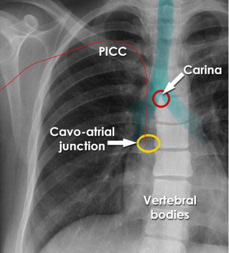 <p>~2 vertebral bodies below the carina.</p>