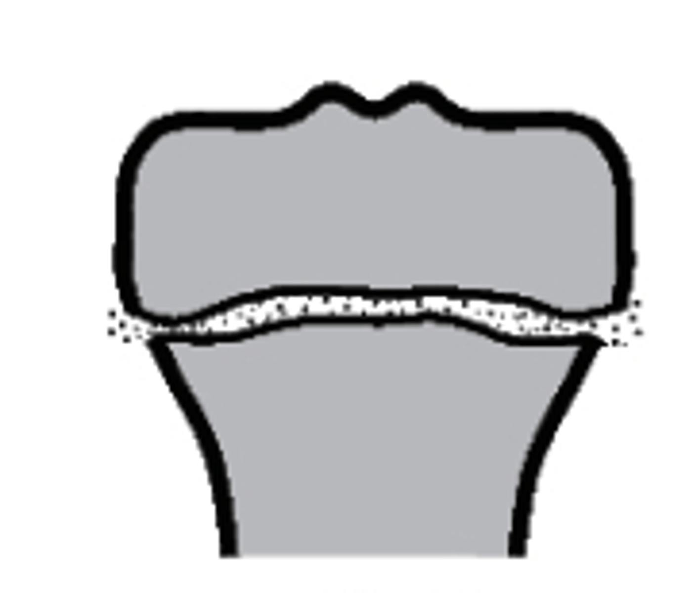 <p>what type of Salter-Harris fracture is this?</p><p>a. Type I</p><p>b. Type IV</p><p>c. Type V</p><p>d. Type II</p>