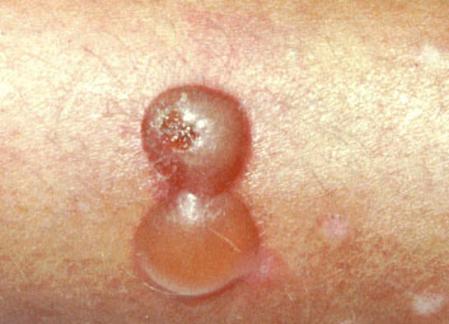 <p>Fluid-filled blisters &gt; 10 mm in diameter. These may be caused by burns, bites, irritant contact dermatitis or allergic contact dermatitis, and drug reactions.</p>