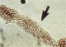 <p>What does this refer to</p><ul><li><p>Protein &lt; 3.5g/day</p></li><li><p>Blood</p></li><li><p>Red blood cells (RBCs)</p></li><li><p>White blood cells (WBCs)</p></li><li><p>Dysmorphic RBCs</p></li><li><p>Acanthocytes (abnormal RBC)</p></li><li><p>Cellular (ie, <strong><u>RBC</u></strong>, WBC) casts</p></li><li><p>Granular casts</p></li></ul><p></p>