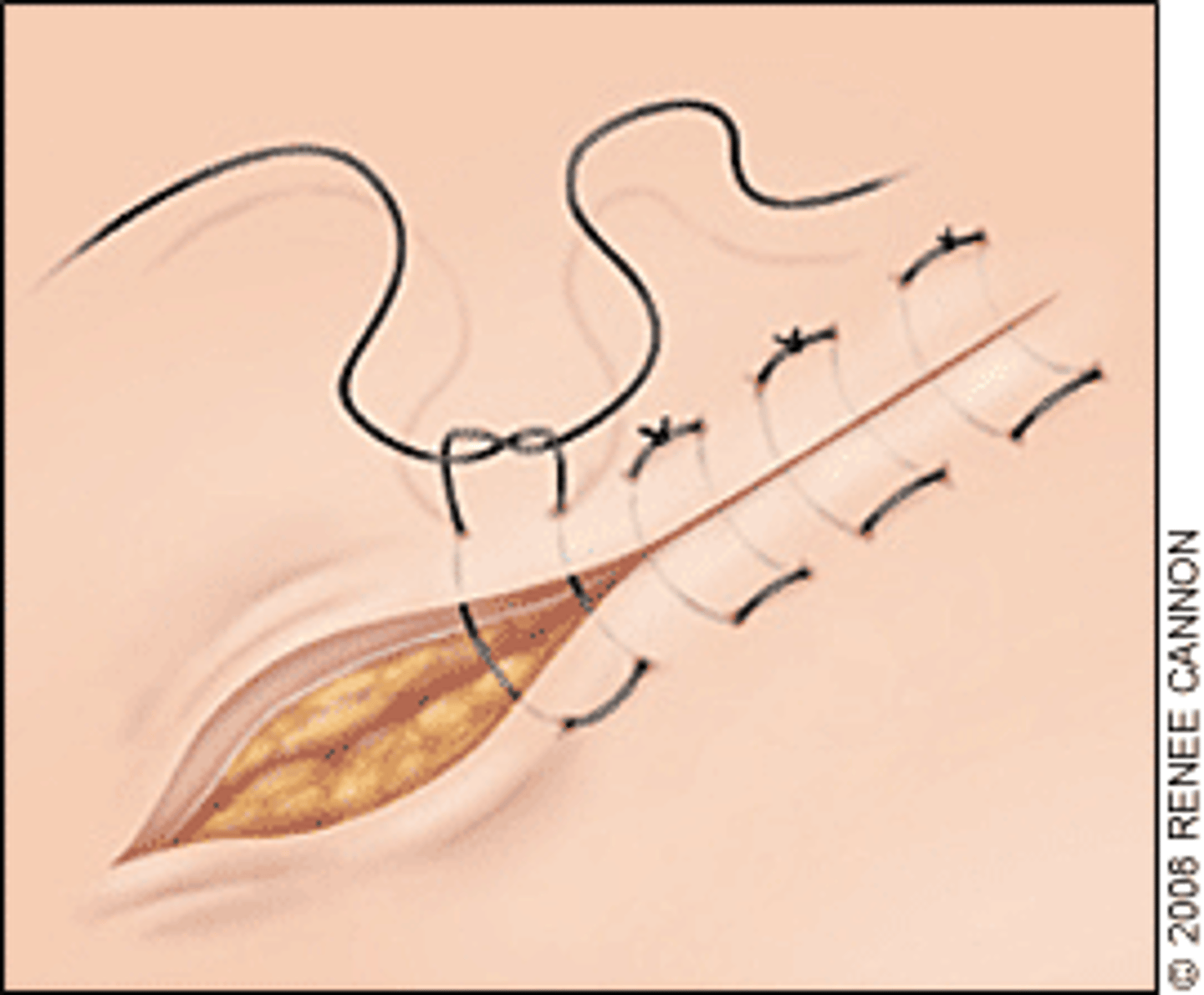 <p>Everting; forms a square and cannot be used for a tension suture</p>