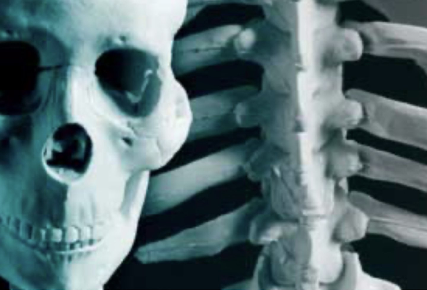 <p>= Lion face</p><p>- Pagets</p><p>- Smashed in look centrally in face</p><p>- Thick ribs and vertebrae</p><p>- ~2% of cases become osteosarcoma</p>