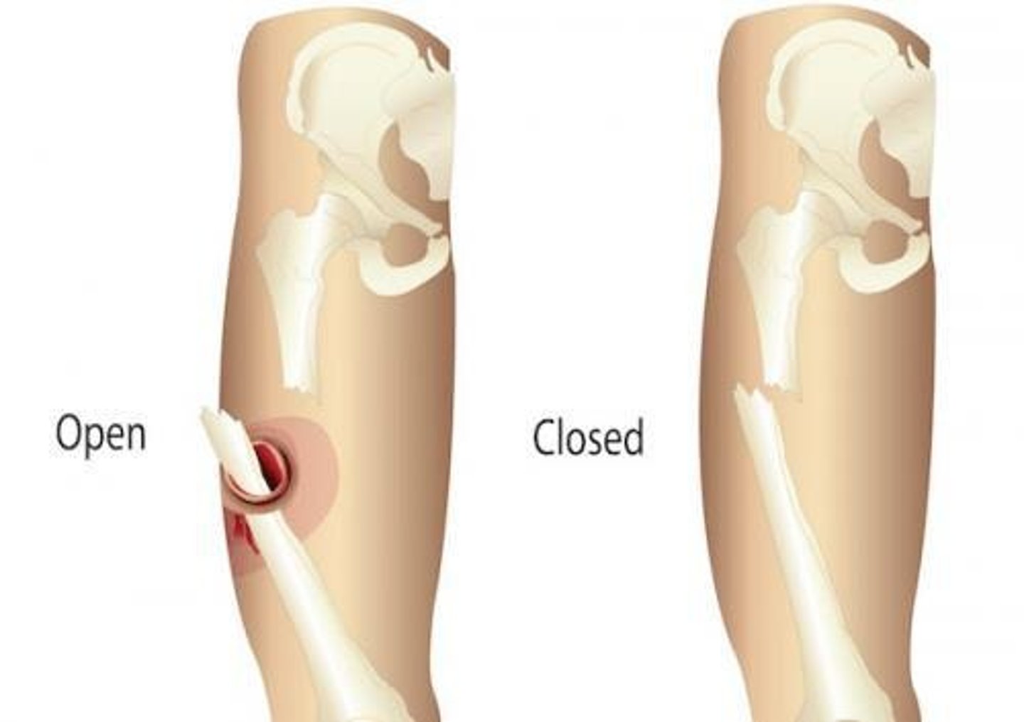 <p>Bone penetrates skin</p>