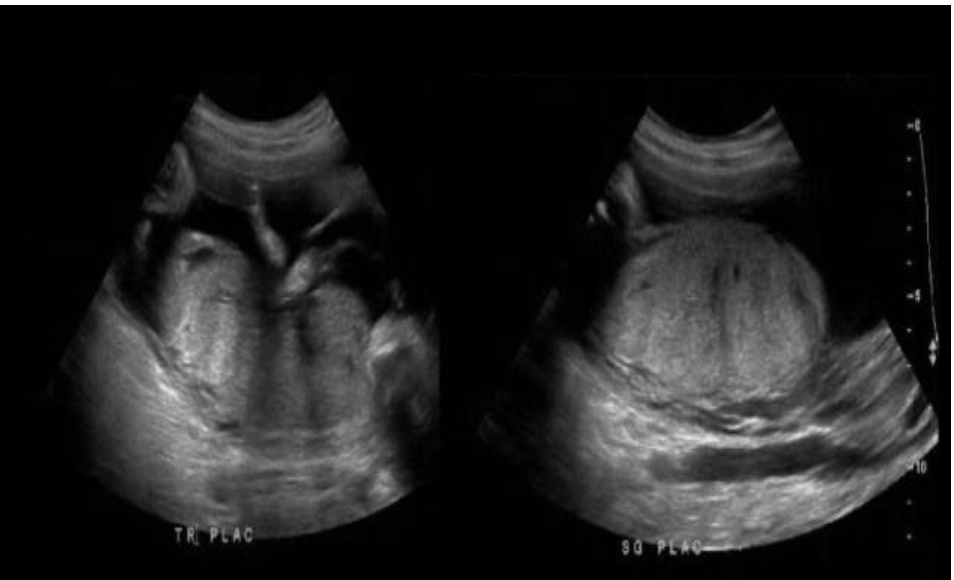<p>a pt is in her <strong>2nd trimester</strong> and the placenta is being evaluated for grading. what grade is this</p><p>a) grade 0</p><p>b) grade 1</p><p>c) grade 2</p><p>d) grade 3</p>