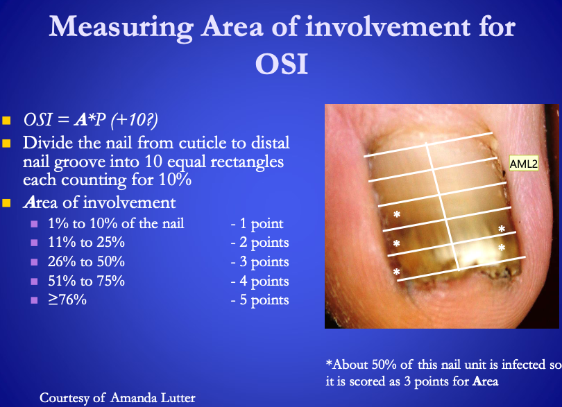 <p>A (max of 5 points) = total area of involvement</p><ul><li><p>1 point – <span><strong>[...]</strong></span> to <span><strong>[...]</strong></span> of nail</p></li><li><p>2 point – <span><strong>[...]</strong></span> to <span><strong>[...]</strong></span> of nail</p></li><li><p>3 point – <span><strong>[...]</strong></span> to <span><strong>[...]</strong></span> of nail</p></li><li><p>4 point – <span><strong>[...]</strong></span> to <span><strong>[...]</strong></span> of nail</p></li><li><p>5 point – <span><strong>[...]</strong></span> of nail&nbsp;</p></li></ul><p></p>