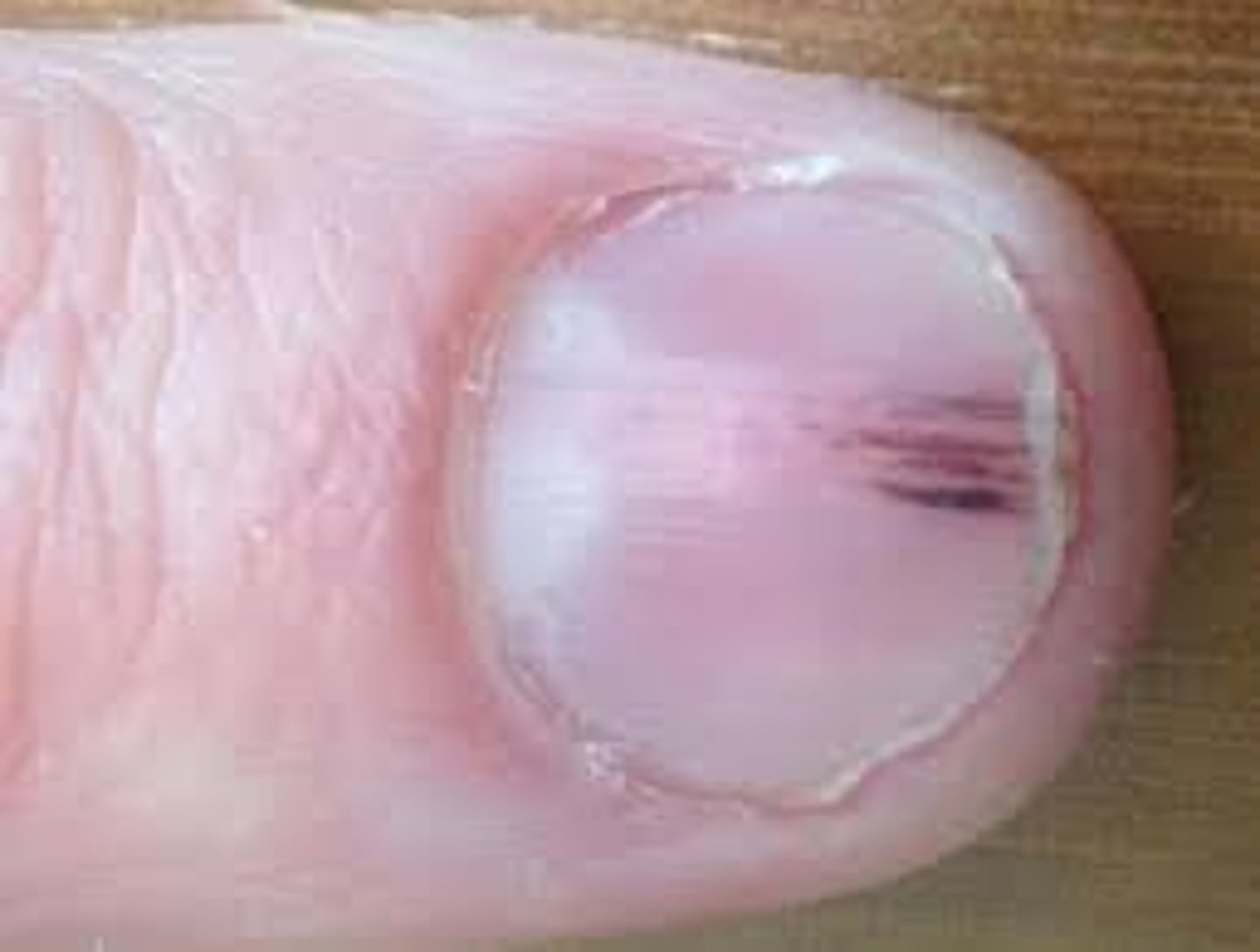 <p>These are little streaks of blood under a patient's nail bed. This is a reason why it's important to assess all aspects of patient in head to toe.</p>