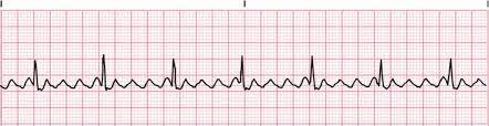- Supraventricular arrhythmia
- Depolarization currents arise from SA but atrial rate too high for all impulses to be conducted through the AV node