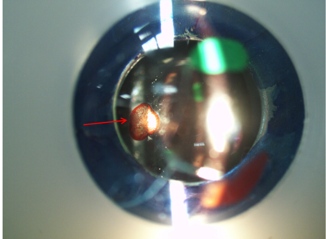 <p>what structure is the lesion on where red arrow pointing</p>