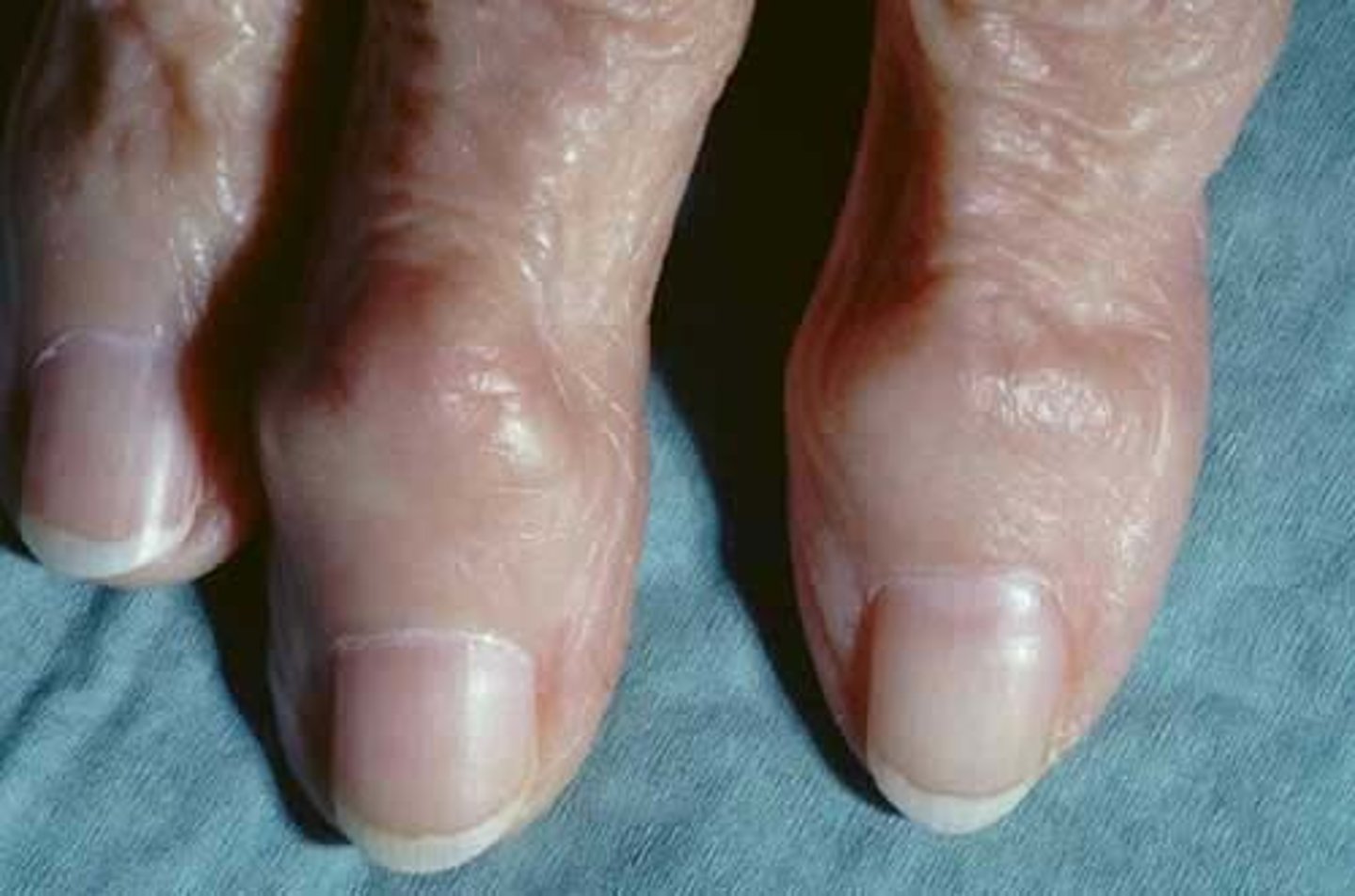 <p>Swelling of distal interphalangeal finger joints, characteristic of osteoarthritis</p>