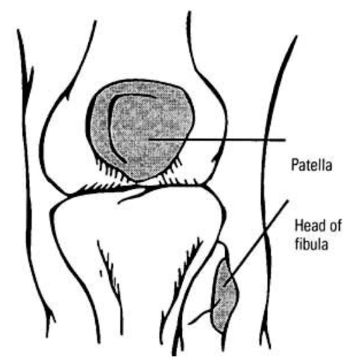 <p>Knee injury patients with ANY of these findings:</p><p>1. Age 55+</p><p>2. Isolated tenderness of patella</p><p>3. Tenderness at head of fibula</p><p>4. Inability to flex to 90</p><p>5. Inability to bear weight both immediately and in the ER (4 steps)</p>