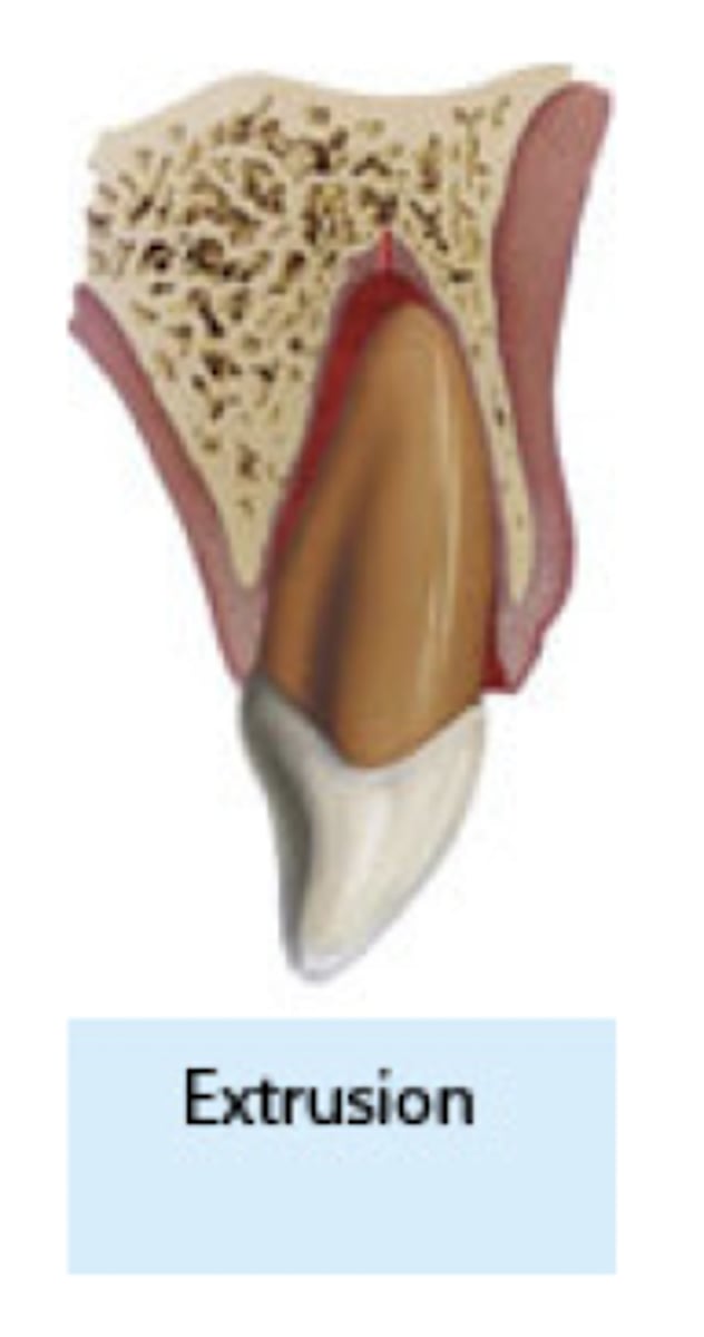 <p>which type of traumatic luxation injury:</p><p>- Elongated, mobile tooth</p><p>- Partial displacement of the tooth out</p><p>of socket.</p><p>- Angulated radiograph: increased PDL space apically</p><p>Treatment:</p><p>- Reposition</p><p>- Stabilize tooth with flexible splint for</p><p>1-2 weeks</p>