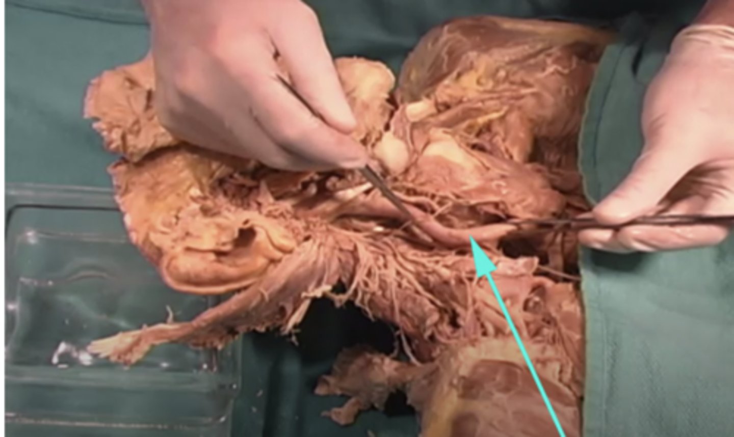 <p>What is the name of the structure as indicated by the arrow?</p><p>-Cranial nerve VIII (8)</p><p>-Jugular vein</p><p>-left common carotid artery</p><p>-right common carotid artery</p>