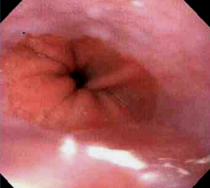 <p>Glandular (intestinal) metaplasia of distal esophageal squamous epithelium due to chronic reflux.</p>