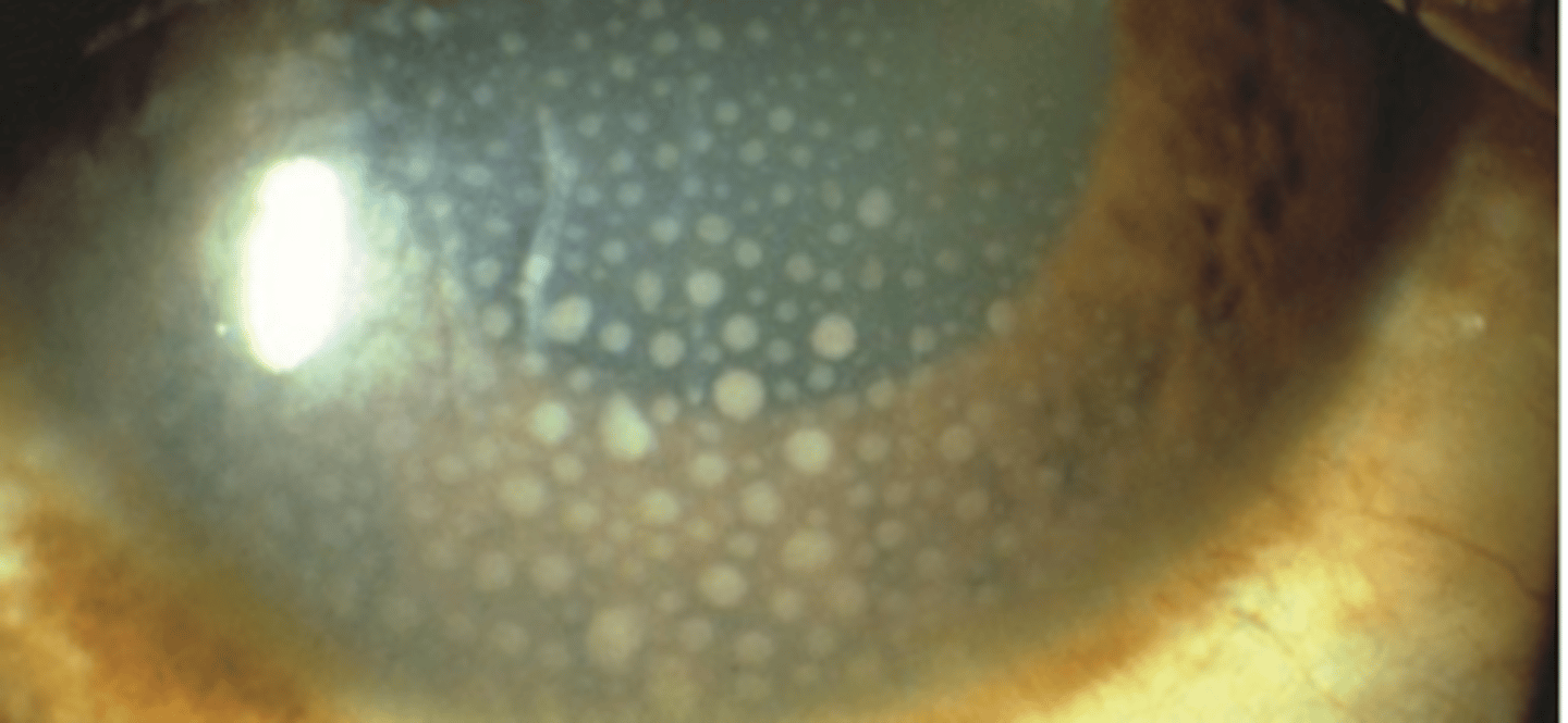 <p>keratic precipitates that are larger and composed of macrophages. Have a greasy appearance and can be diffuse or localized.</p>