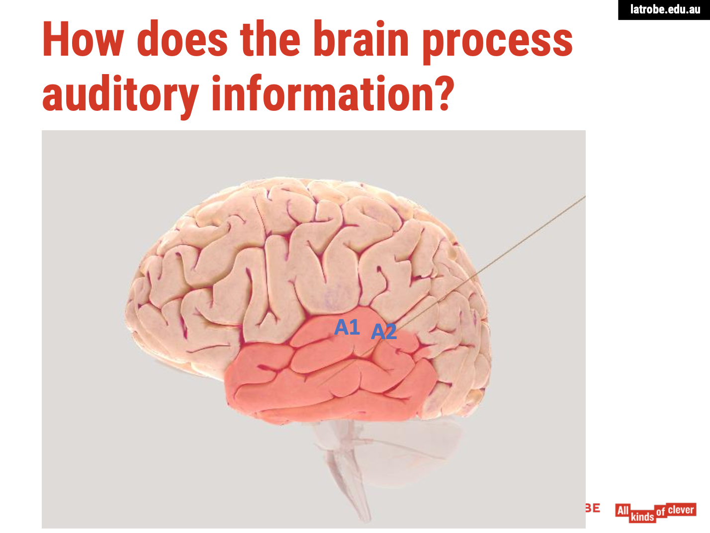 <p><span><strong>Overview of A1 Function</strong></span></p><ul><li><p><span><strong>Location</strong>: The&nbsp;<strong>superior temporal gyrus</strong>&nbsp;contains the&nbsp;<strong>primary auditory cortex (A1)</strong>, which plays a crucial role in processing basic auditory information.</span></p></li><li><p><span><strong>Function</strong>: A1 is responsible for detecting:</span></p><ul><li><p><span><strong>Pitch</strong>: The frequency of sounds.</span></p></li><li><p><span><strong>Loudness</strong>: The amplitude of sounds.</span></p></li><li><p><span><strong>Location</strong>: The spatial origin of sounds.</span></p></li></ul></li></ul><p><span><strong>Consequences of Damage</strong></span></p><ol type="1"><li><p><span><strong>Impaired Sound Perception:</strong></span></p><ul><li><p><span><strong>Individuals may experience a&nbsp;reduction in their ability to perceive sounds&nbsp;accurately. They may struggle to hear specific pitches or loudness levels, leading to a general decline in auditory perception.</strong></span></p></li></ul></li><li><p><span><strong>Difficulty Discriminating Sounds:</strong></span></p><ul><li><p><span><strong>Damage to A1 can impair the ability to&nbsp;discriminate between different sounds. For instance, an individual might have trouble distinguishing between similar-sounding musical notes or voices, impacting their ability to understand speech.</strong></span></p></li></ul></li><li><p><span><strong>Challenges in Sound Localization:</strong></span></p><ul><li><p><span><strong>The loss of neurons responsible for sound localization may result in difficulties in determining where a sound is coming from. Individuals may struggle to identify the direction or distance of auditory stimuli, affecting their spatial awareness.</strong></span></p></li></ul></li><li><p><span><strong>Auditory Processing Disorders:</strong></span></p><ul><li><p><span><strong>Individuals may develop&nbsp;auditory processing disorders, where they can hear sounds but struggle to process and interpret them. This can lead to challenges in understanding conversations, particularly in noisy environments.</strong></span></p></li></ul></li><li><p><span><strong>Emotional and Social Implications:</strong></span></p><ul><li><p><span><strong>These auditory processing difficulties can have significant emotional and social implications, making it hard for individuals to engage in conversations or enjoy music and other auditory experiences. This can lead to frustration, social withdrawal, or feelings of isolation.</strong></span></p><img src="https://knowt-user-attachments.s3.amazonaws.com/dde4a905-b1fe-4e77-bb5d-73a97b49bebd.png" data-width="100%" data-align="center"></li></ul></li></ol><p></p>