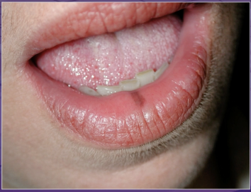 <p>dx</p><p>varix </p><p>melanotic macule </p><p>melanoma </p><p>hemagioma </p>