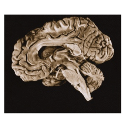 <p>What view of the brain is this </p>