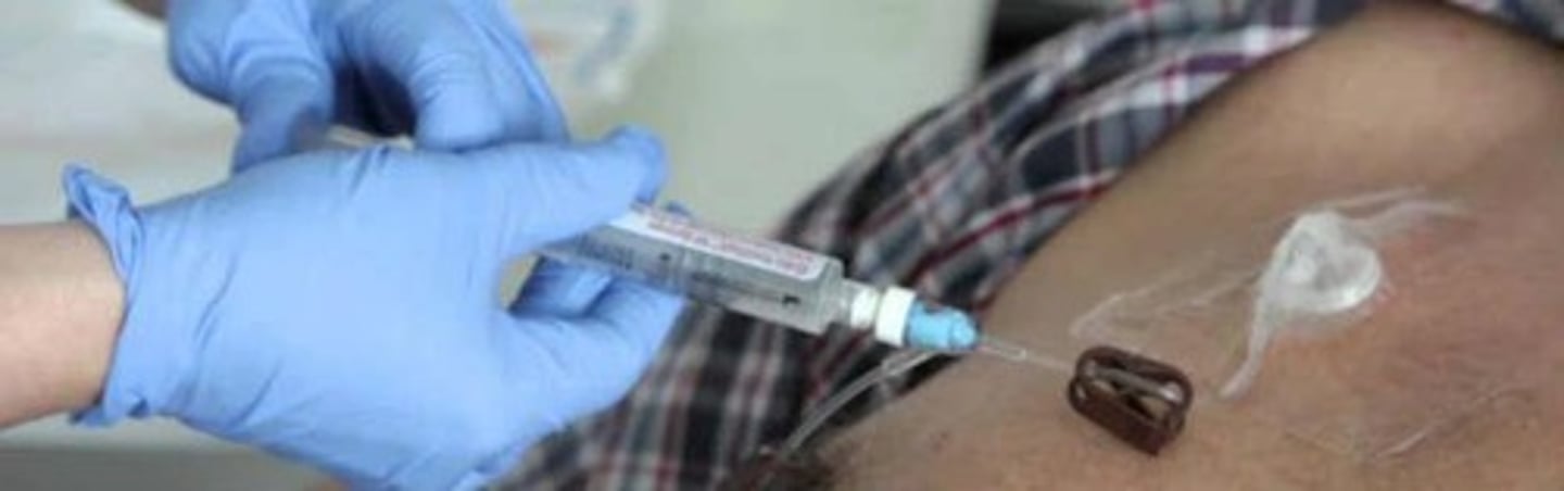 <p>- Implanted reservoir in chest or arm with a catheter tunneled to access a vein, used for long-term venous access and provides the lowest rate of infection. Prevents clots</p><p>- When not in use, reservoir is Heparin locked. When needed, reservoir accessed w/ special access needle</p>