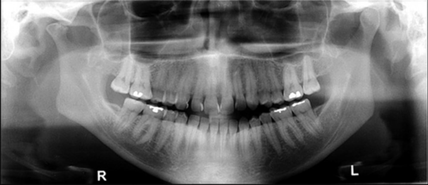 <p>What is this developmental abnormality, and what is the etiology for it?</p>