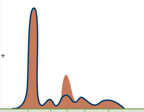 <p>Increase in acute phase proteins in α2 region<br>Takeaway: Decreased Albumin, increased α1 &amp; α2, normal gamma</p>