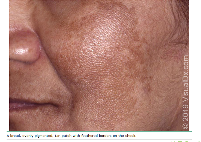 <p>chronic, recurring disorder of hyperpigmentation arising from hyperfunctinal melanocytes that deposit excessive amts of melanin in epidermis and dermis; cause unknown</p>